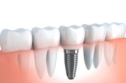 Everything You Need To Know About Dental Implants