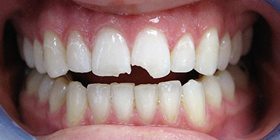 Before dental bonding — Dental Arts of Boston