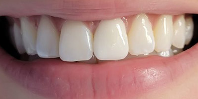 After porcelain veneers Boston — Dental Arts of Boston