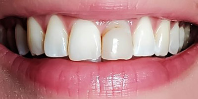 Before porcelain veneers Boston — Dental Arts of Boston