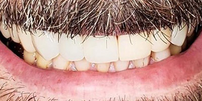 After dental bridge Boston — Dental Arts of Boston