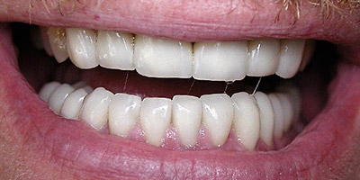 After lower crowns bruxism treatment Boston — Dental Arts of Boston