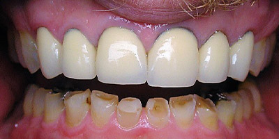 Before lower crowns bruxism treatment Boston — Dental Arts of Boston