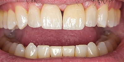 Image for Single Porcelain Veneer Replacement