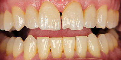 Image for Single Porcelain Veneer Replacement