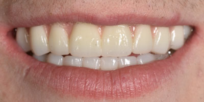 After All-on-X dental implants Boston — Dental Arts of Boston