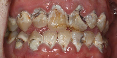 Before All-on-X dental implants Boston — Dental Arts of Boston