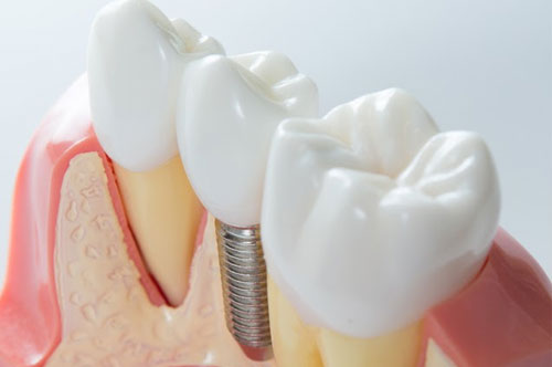 5 Facts You Didn’t Know About Dental Implants